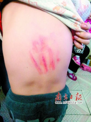 The mark left on the back of Peng Hueng, aged six, a week after being beaten. (From the internet)